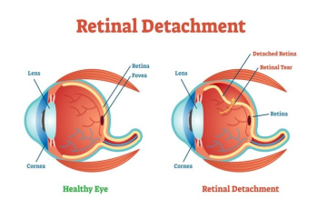 Symptoms, Causes, Types, Risk Factors, Diagnosis, Stages, Treatment, and Prevention of Diabetic Retinopathy