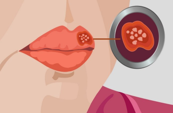 Herpes: Symptoms and Causes. Treatment and prevention