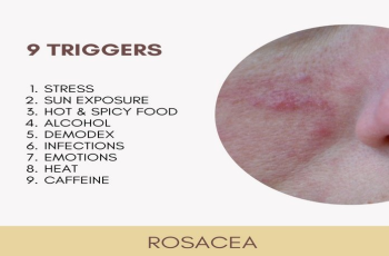 Rosacea: Types, Causes, Symptoms and Treatment