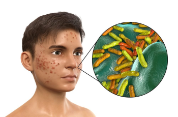 What is Acne? Definition, Symptoms, Causes, Types, Risk Factors, Complications, Home Remedies, Treatment