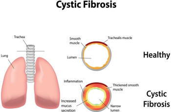 Overview, Symptoms, Causes, Treatment, Complications, Prevention, and Management of Cystic Fibrosis