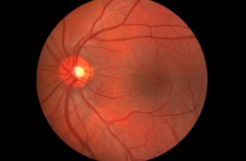 Causes, Symptoms, and Remedies for Macular Degeneration