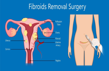 Uterine Fibroids – Definition, Symptoms and Causes. Types of fibroids. Natural Treatments. Herbal Remedies. Medical Treatment.