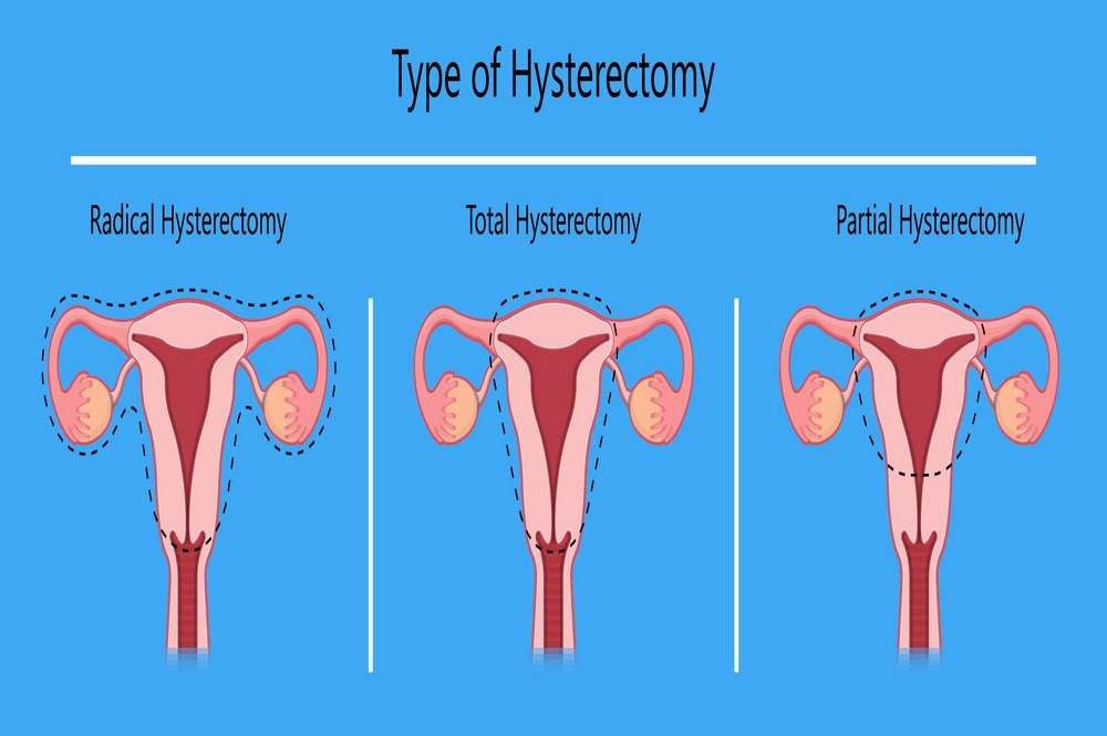 Uterine Fibroids Definition Symptoms And Causes Types Of Fibroids