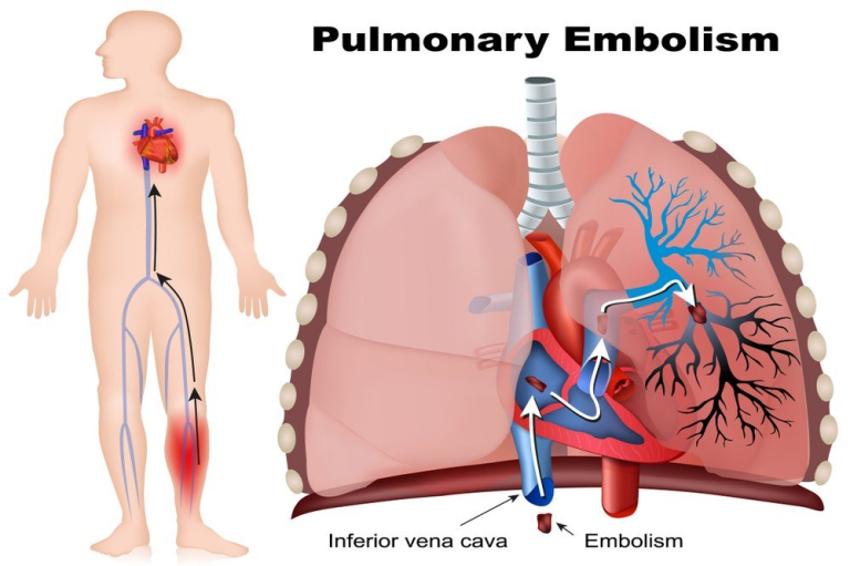 Pulmonary Embolization (Blood Clots in Lungs) Symptoms. Causes