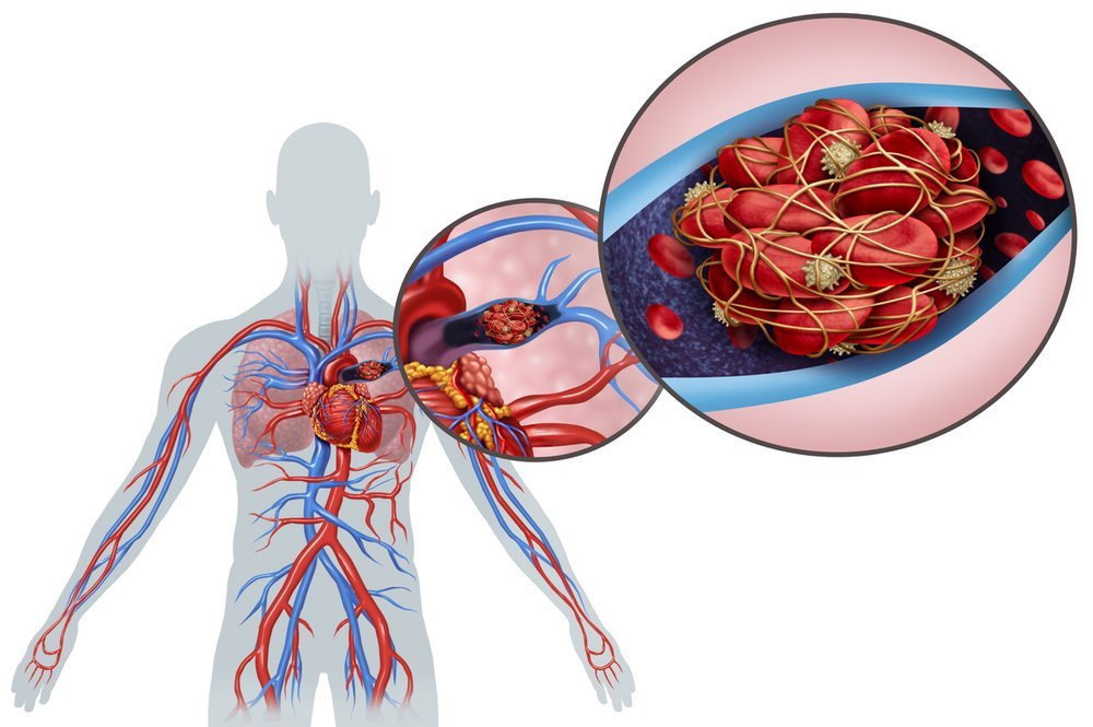 pulmonary-embolization-blood-clots-in-lungs-symptoms-causes