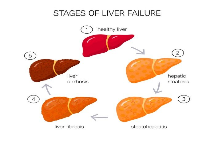 What is liver disease? What are the symptoms, causes, diagnosis ...