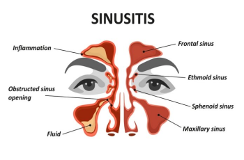 Sinusitis (Infection of the Sinus): Causes and Symptoms. Risk Factors. Complications. Diagnosis. Treatment.
