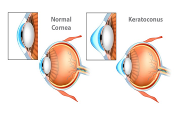 What Is the Definition of Astigmatism? Symptoms, Causative Factors, Diagnosis, and Treatment
