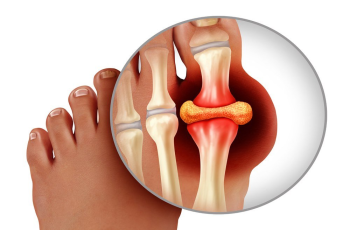 Definition, Symptoms, Causes, Diagnosis, Types, Pathophysiology, Medications, Complications, Treatment, and Home Remedies (Foods To Avoid & Foods To Eat) for Gout.