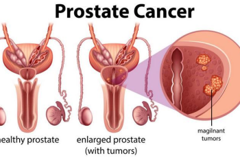 What Constitutes Prostate Cancer? Prostate Cancer Manual