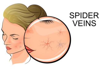The Symptoms, Causes, Treatment, and Prevention of Spider Veins