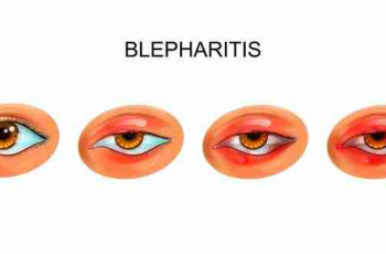 What Is Blepharitis (Inflammation of the Eyelids)? Symptoms, causes, risk factors, diagnosis, home remedies, treatment, complications, and prevention are discussed.